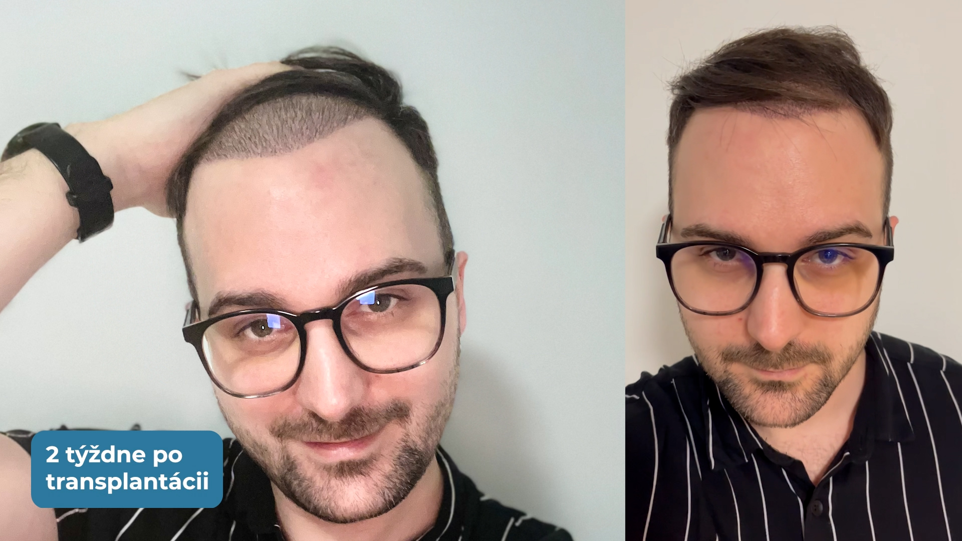 NESTORY - Transplantácia